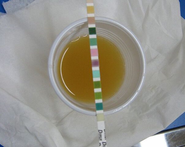 Prévention de l’infection urinaire, chez l’homme et la femme