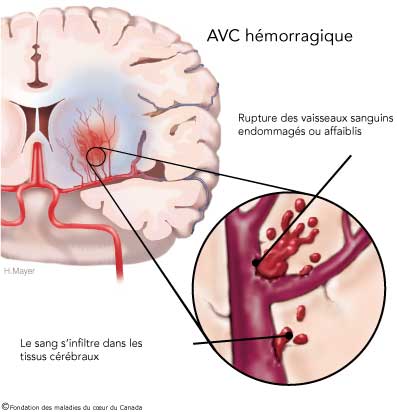 Le magazine du 01/11/2018:AVC : causes, signes et séquelles expliqués par un spécialiste