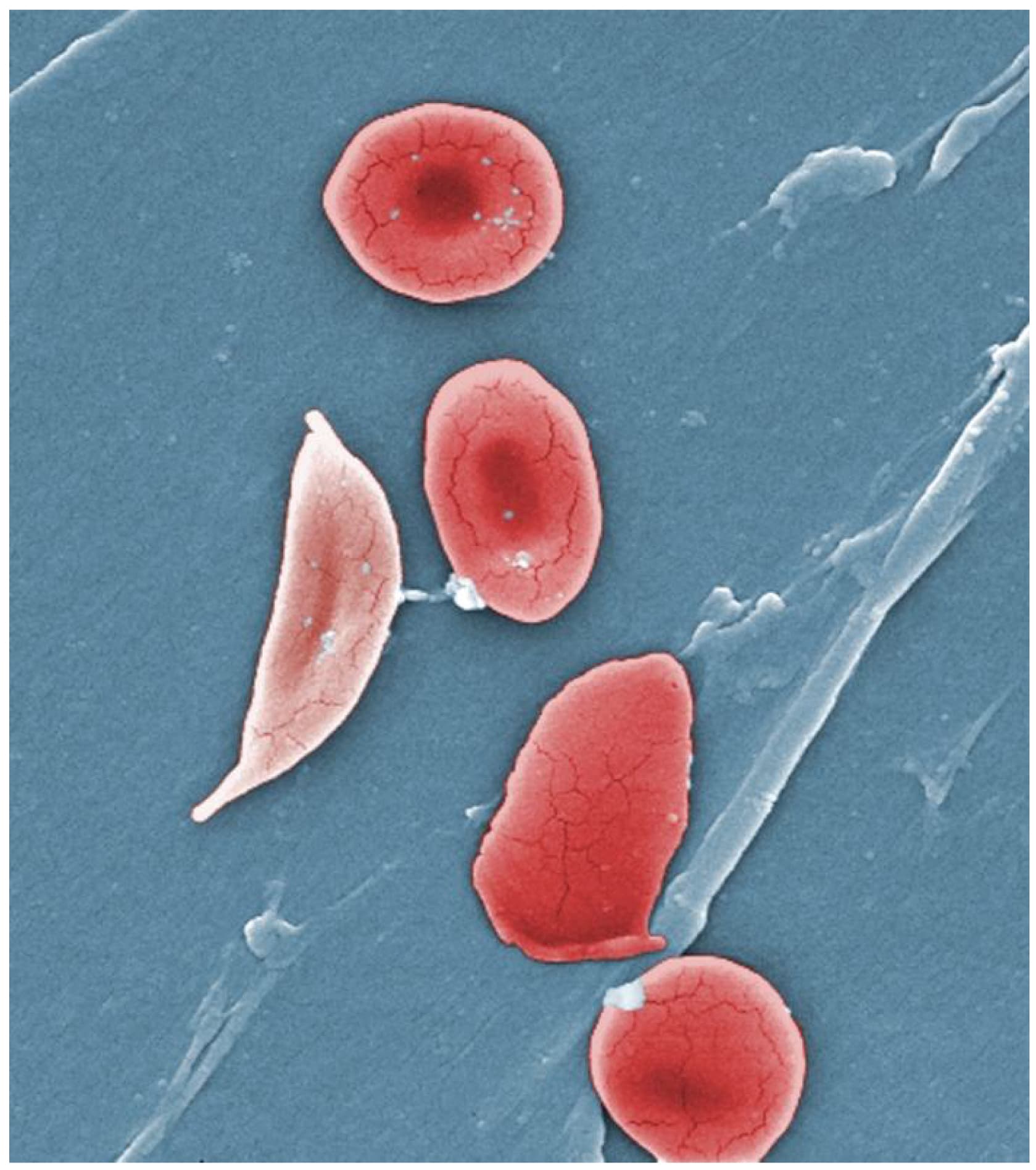 Drépanocytose, une maladie de sang