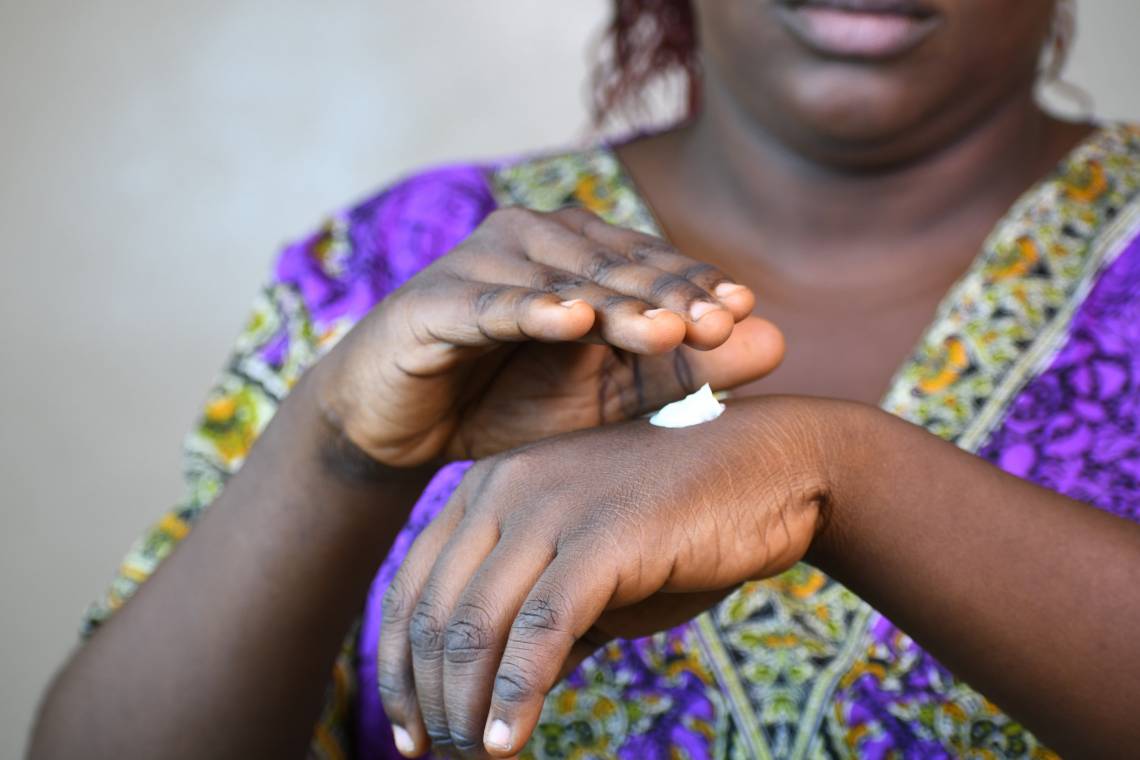 Impact des produits éclaircissants de tout genre qui envahissent les marchés au Niger sur la santé de la peau chez les femmes