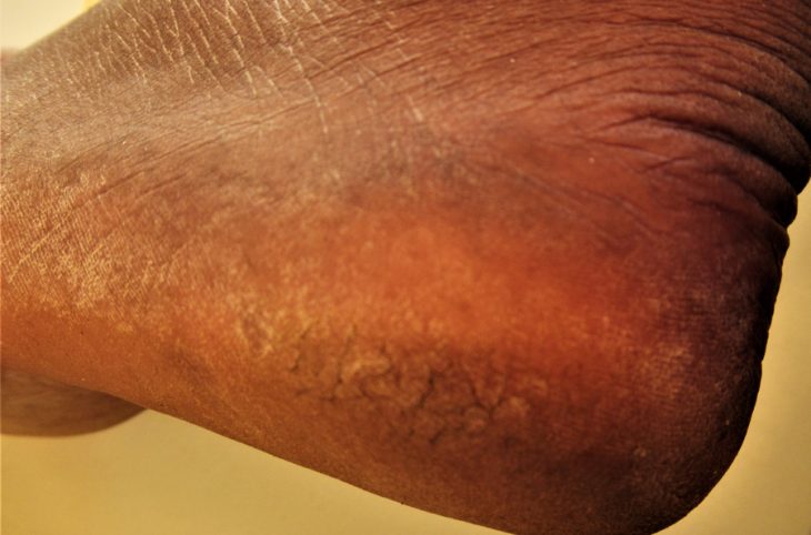 Le magazine du 17/01/2019 : La gerçure sur la plante du pied, un facteur dérangeant surtout pendant le froid